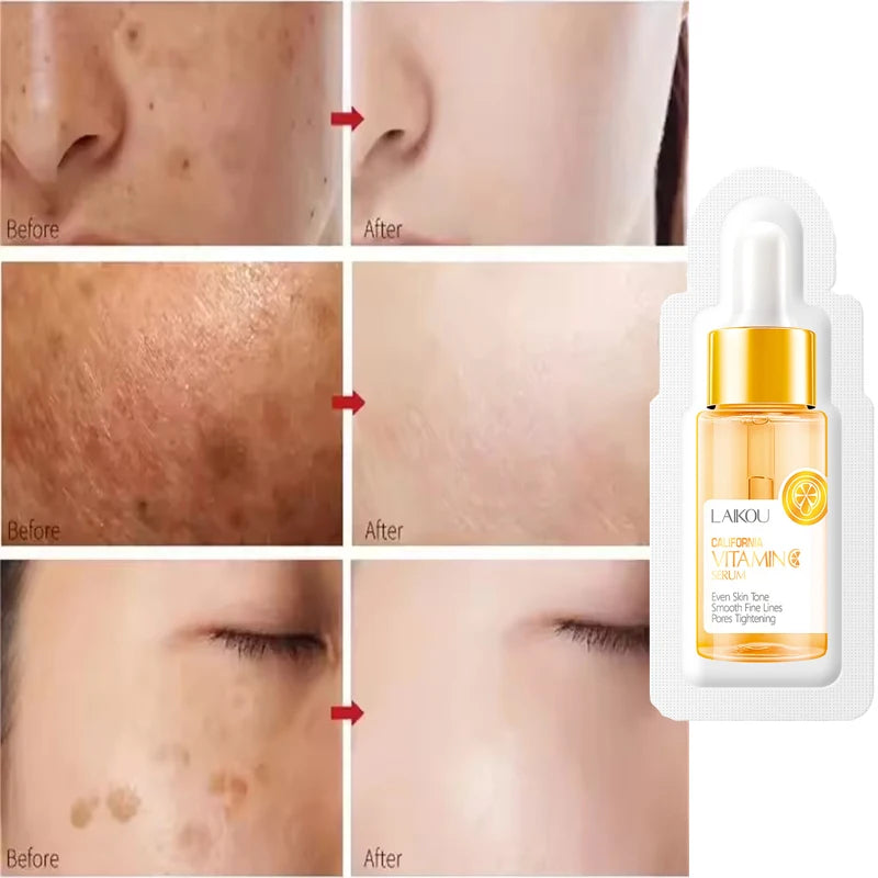Vitamin C Whitening Serum Freckle Remove Essence Fade Pigmentation Melasma Dark Spots Corrector Repair Serum Korean Skin Care