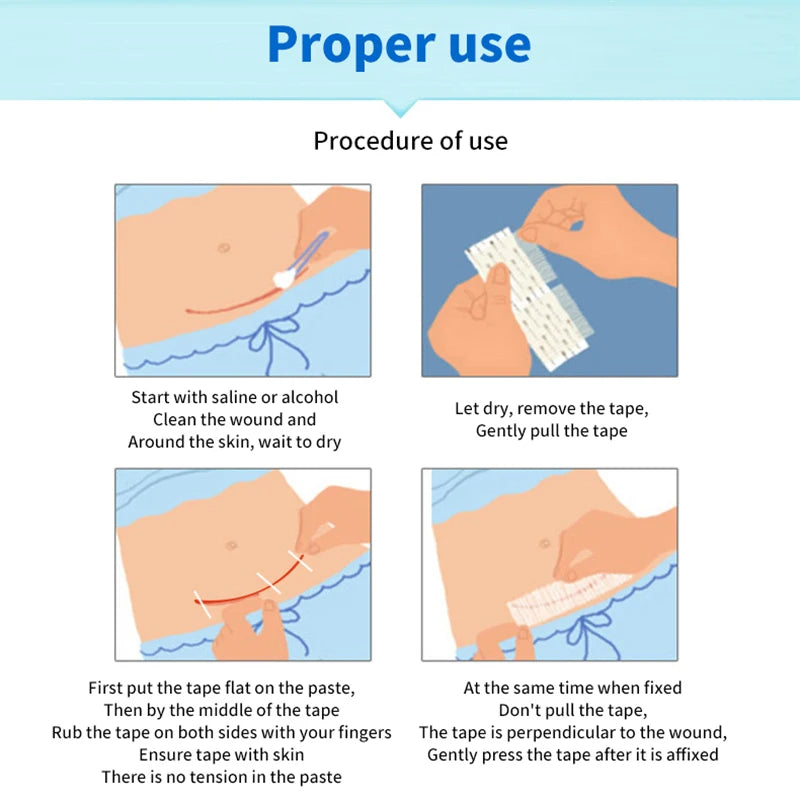 5 Strips Wound Skin Closure Strips Postpartum Wound Repair Cosmetic Surgery Strip Adhesive Medical Suture Free Surgical Tape